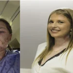 World-First Exosome Therapy Helps Save Burn Survivor’s Face