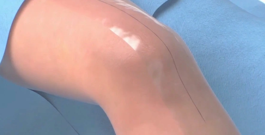 BRIJ Medical Expands Incision Management Portfolio with an Advanced Wound Sealant