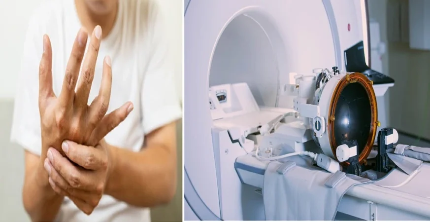 How MRgFUS is Transforming Treatment for Parkinson's Disease, Essential Tremor