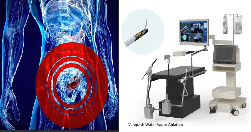 Vanquish Water Vapour Ablation Performed on Patient with Localized Prostate Cancer