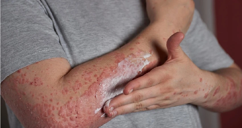 Johnson & Johnson Reports Long-Term ICOTYDE Efficacy in Plaque Psoriasis