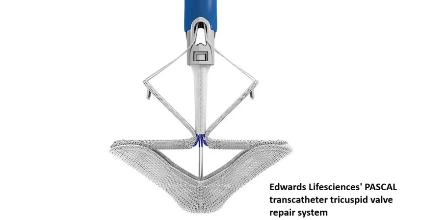US FDA Approves Edwards’ PASCAL Precision System for Tricuspid Valve Repair